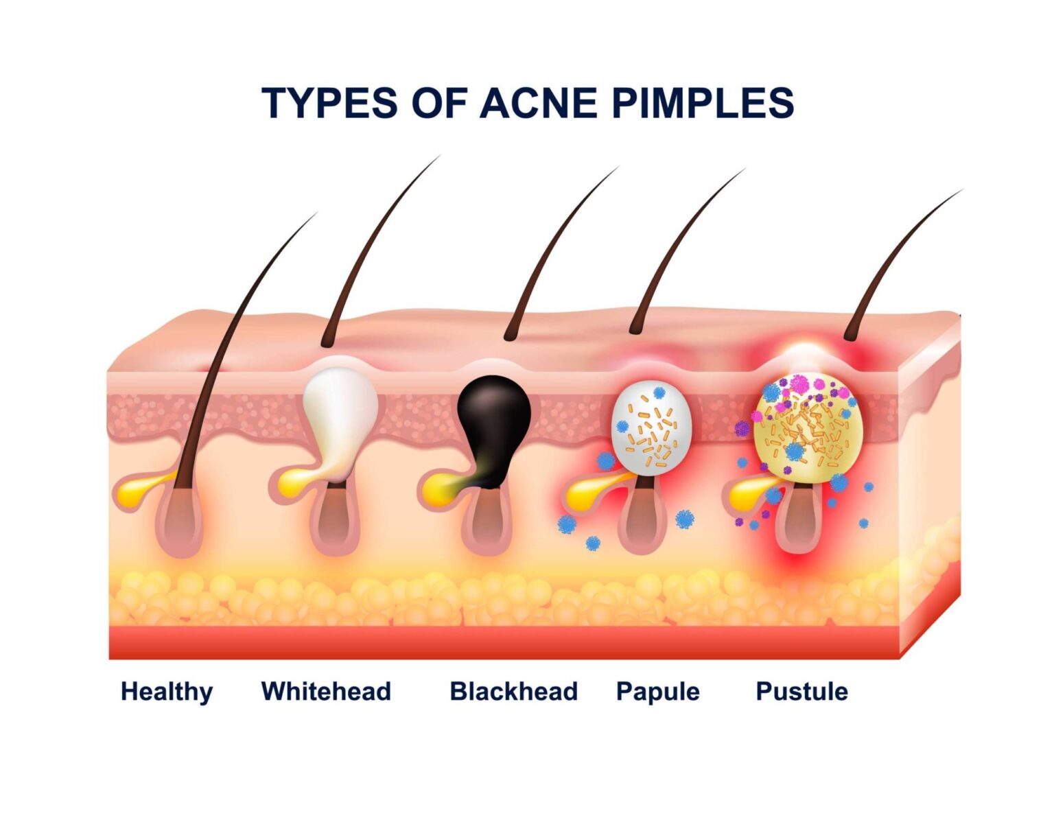 Acne/Pimples - Urmil Skin Clinic