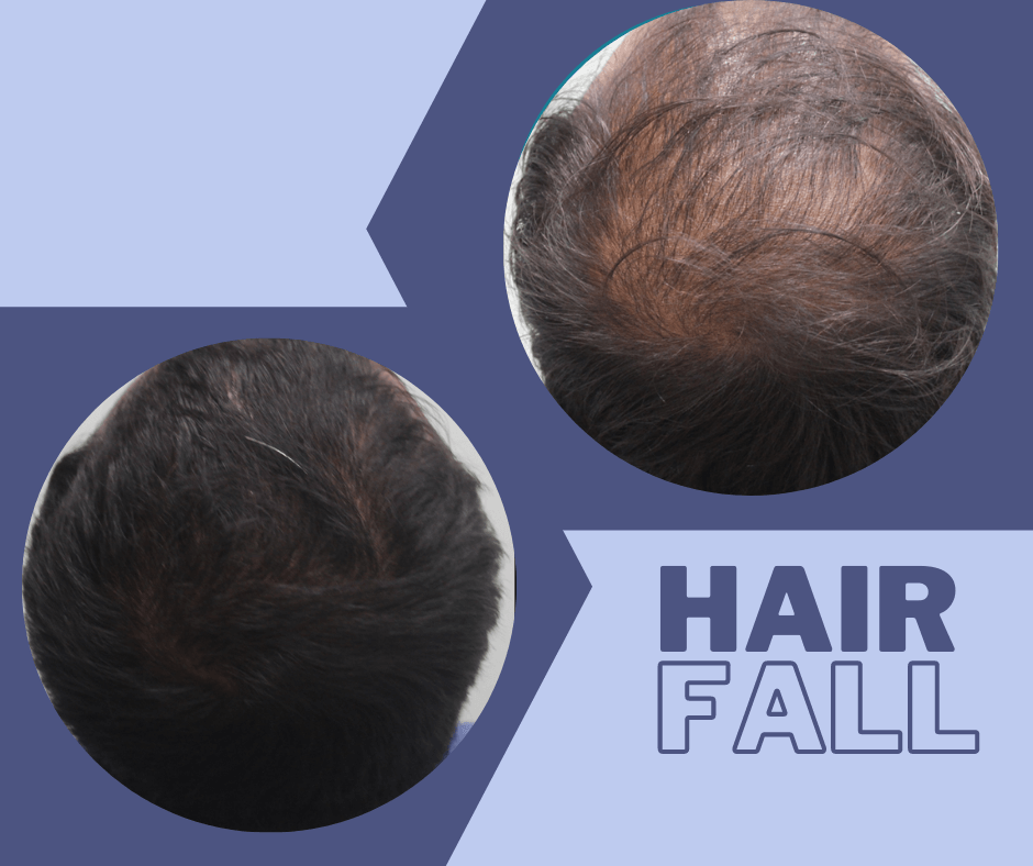 hair fall