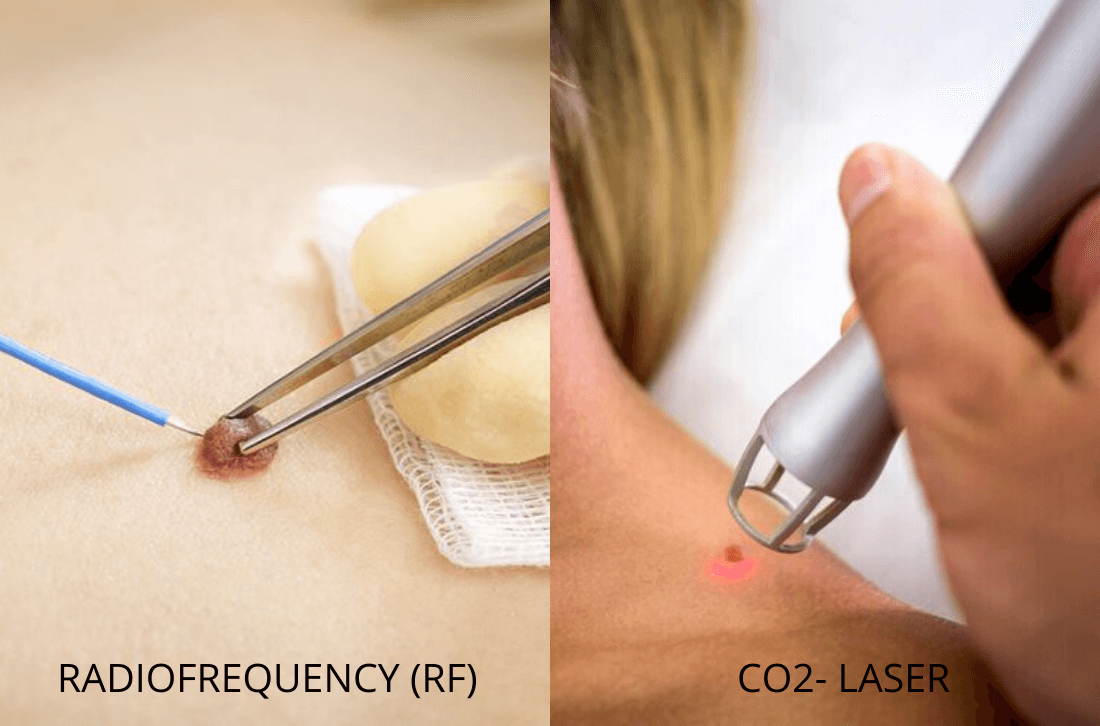 CO2-LASE and RF